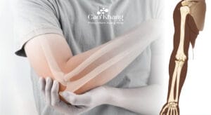 giải phẫu xương cánh tay