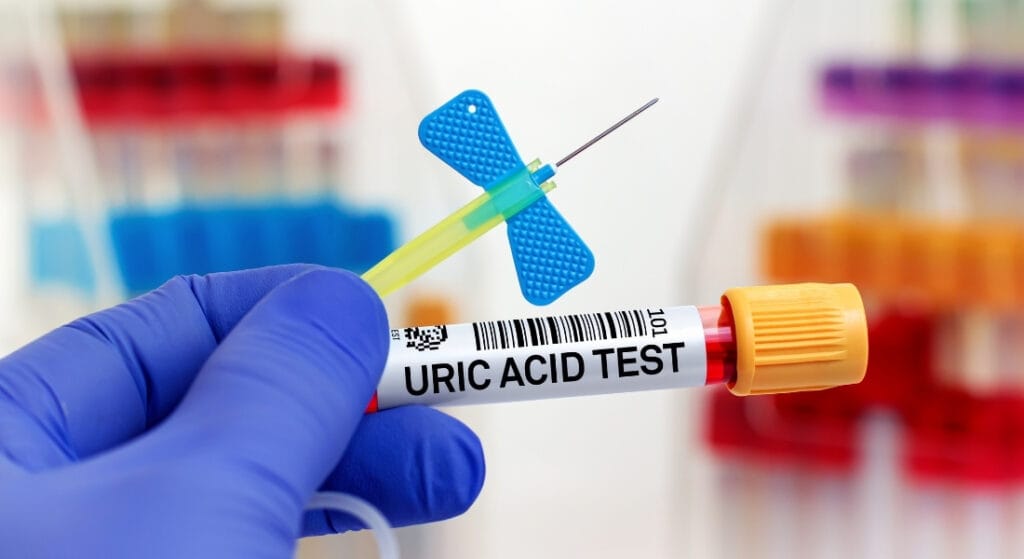 Kiểm tra acid uric trong máu