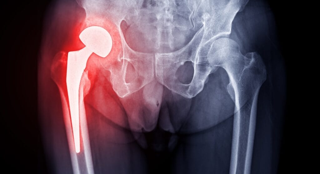 nguyên nhân đau khớp háng bên phải