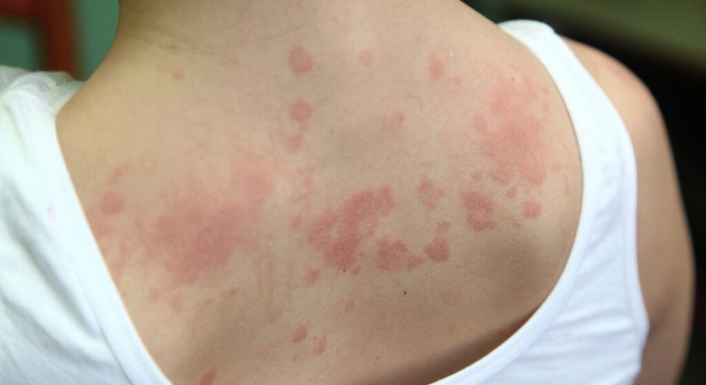 phát ban sau khi cấy chỉ