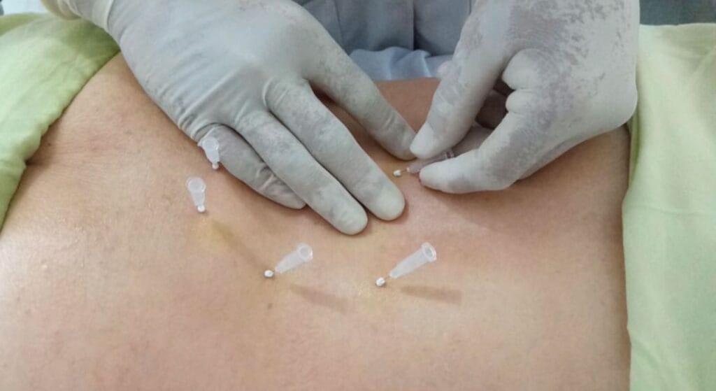 quy trình cấy chỉ chữa bệnh xương khớp