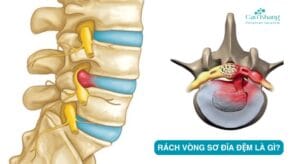 rách vòng sơ đĩa đệm