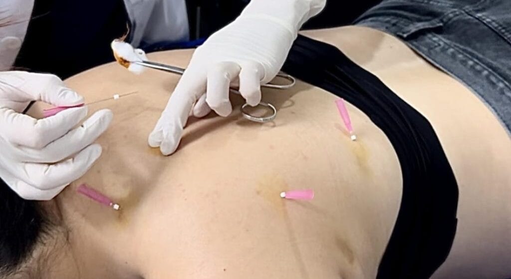 tác dụng phụ sau cấy chỉ