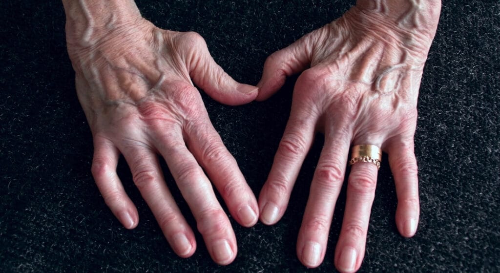 tiêu chuẩn chẩn đoán viêm khớp dạng thấp