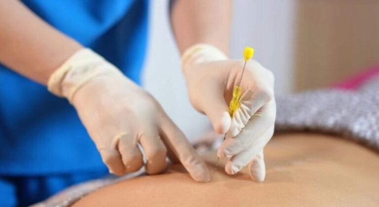 triệu chứng sau khi cấy chỉ