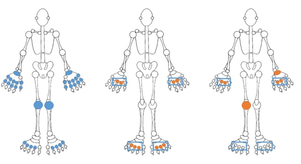 viêm khớp dạng thấp