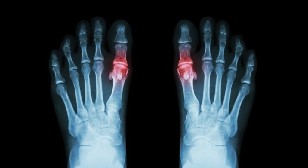 viêm khớp dạng thấp