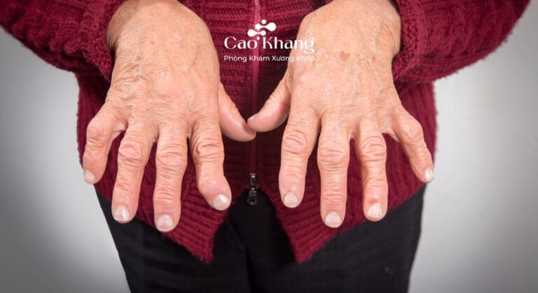 viêm khớp dạng thấp huyết thanh dương tính