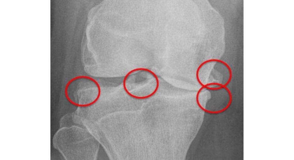 x-quang gai khớp gối