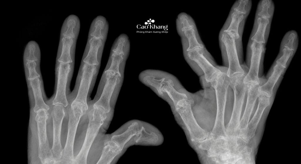 x quang viêm khớp dạng thấp