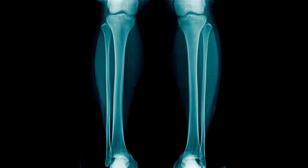 x-quang xương ống chân