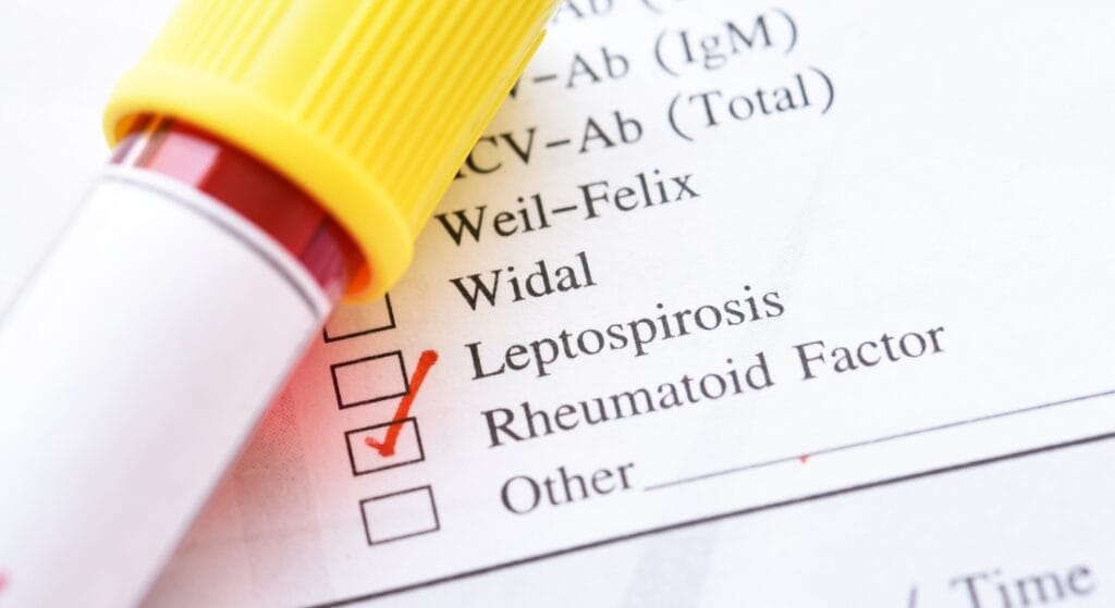xét nghiệm chẩn đoán viêm khớp dạng thấp